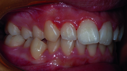 Cross-bite monolaterale e mandibular-shift. Trattamento con espansore palatino al nickel-titanio