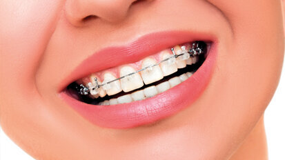 Ortodonzia: successi effimeri, problemi duraturi?