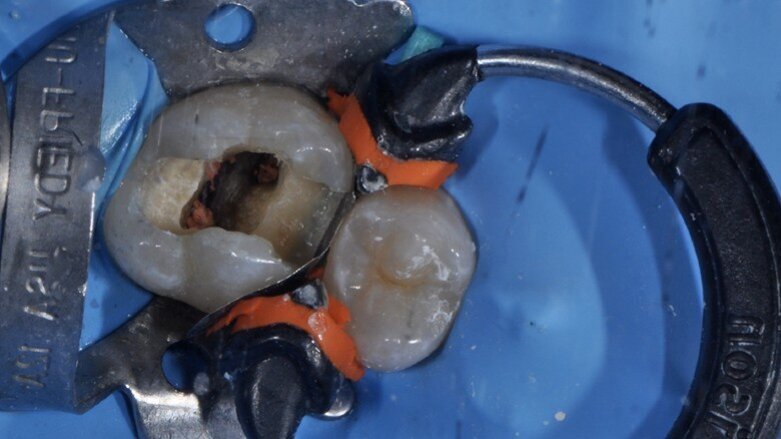 Trattamento endodontico ortogrado con strumenti trattati termicamente