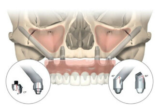 Nobel Biocare – NobelZygoma