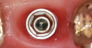 Vantaggi clinici del carico immediato con impianto Cono Morse