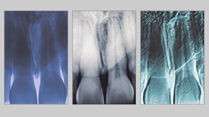 Estética y blanqueamiento dental en la era digital  (Capítulo 8)