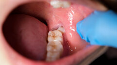 Singapore dentists debate new competency pathway for third molar surgery