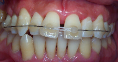 L'orthodontie sans attaches fixes
