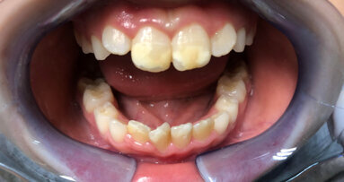 Curasept Biosmalto Mousse: wspomaga leczenie ortodontyczne pacjentów z defektami szkliwa i MIH