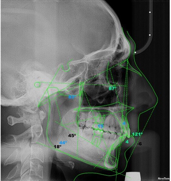 Fig. 28: Ricketts cephalometric analysis four years after treatment (image generated using NemoCeph Studio).