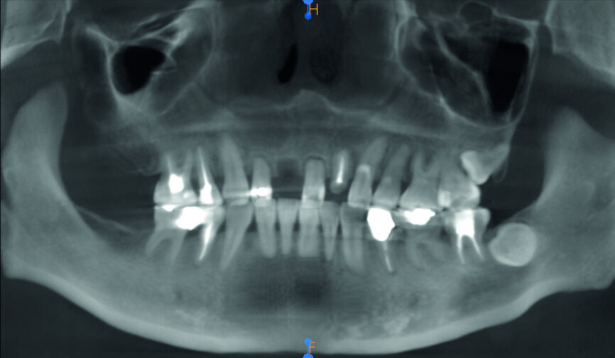Fig. 3: Pre-op panoramic radiograph.
