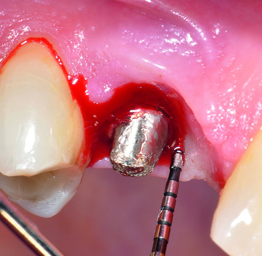 Fig. 1b: Implant in position #14 affected by peri-implantitis: periimplant probing a) with the prosthetic crown in situ and b) after prosthetic crown removal.