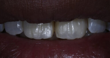 Bringing anterior direct restorations to life using surface textures