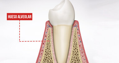 Biointegración cervical periimplantaria. Bundle Bone