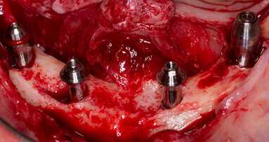 Impianti sotto-crestali GTB e impianti zigomatici per la riabilitazione dei mascellari atrofici