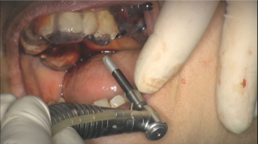 Figg. 48, 49_Inserimento impianto.