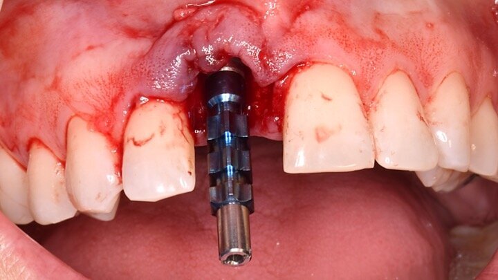 Figura 9. Antes de realizar el relleno con las partículas de biomaterial retiramos el transportador y lo sustituimos por el Transfer de impresiones. De esta forma, impedimos que alguna partícula de biomaterial penetre en la conexión y nos cree un ‘gap’ en la impresión.