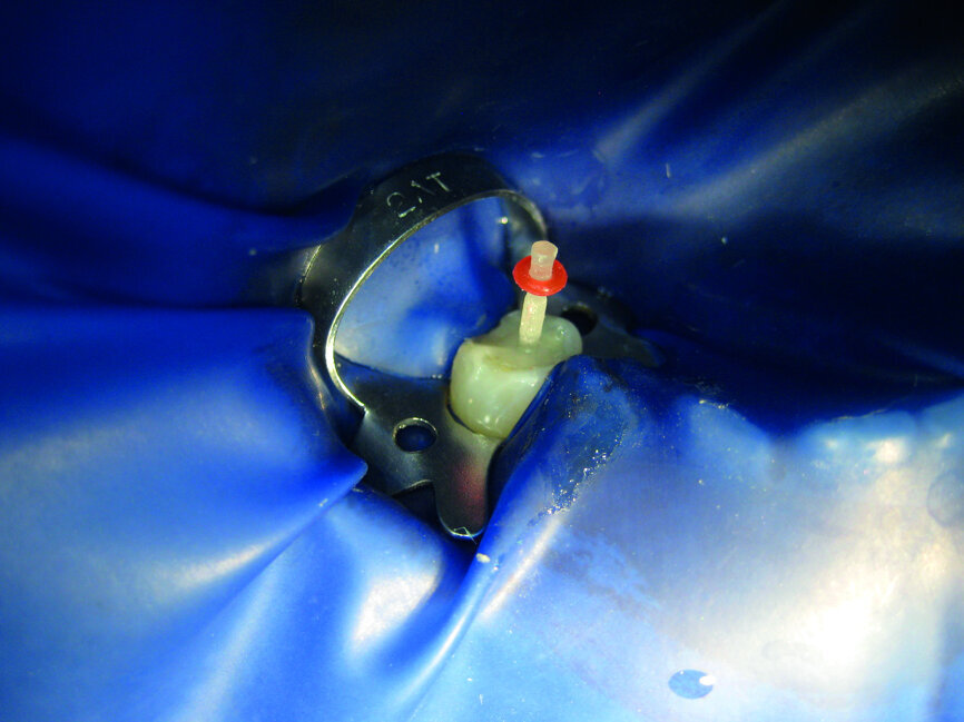 Fig. 3: Bonding of a fibre-reinforced composite post under a rubber dam (LuxaCore Dual, DMG).