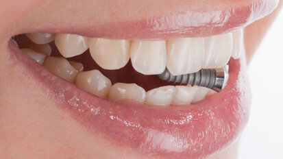 Teilimplantate für TGKK-Mitglieder