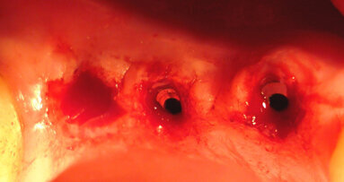 Aspetti clinici ed ergonomici dell’utilizzo del laser a diodi nella fase di scopertura implantare della tecnica “two stages”