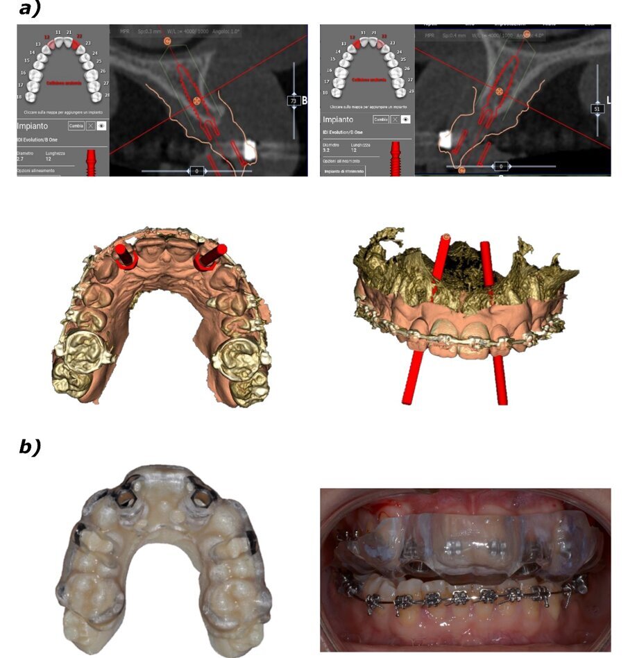 Fig. 3_Progettazione digitale; a) progettazione di inserimento degli impianti B1ONE in corrispondenza degli elementi 22 e 12 – viene evidenziata la traiettoria di inserimento implantare; b) realizzazione di dima chirurgica per inserimento guidato.