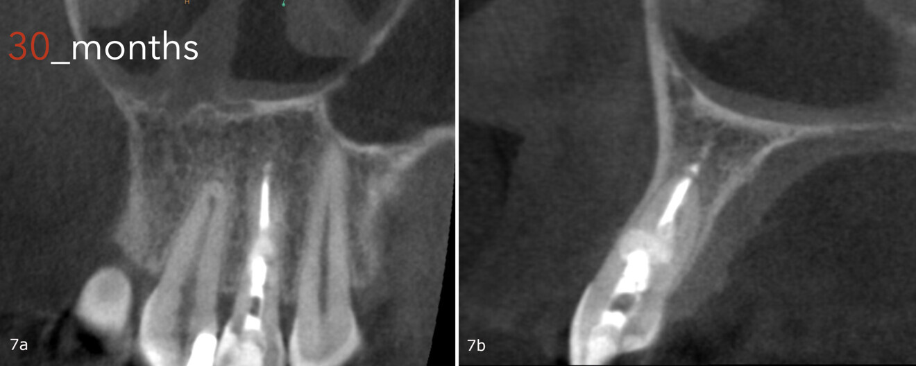 Figs. 7a & b: CBCT scan taken 30 months after the treatment, showing the healed lesion.