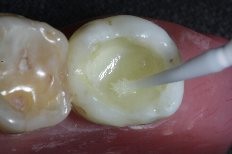 Fig. 26b: The first dose of fibre-reinforced membrane cube is applied into the cavity to protect the walls of the large cavity.