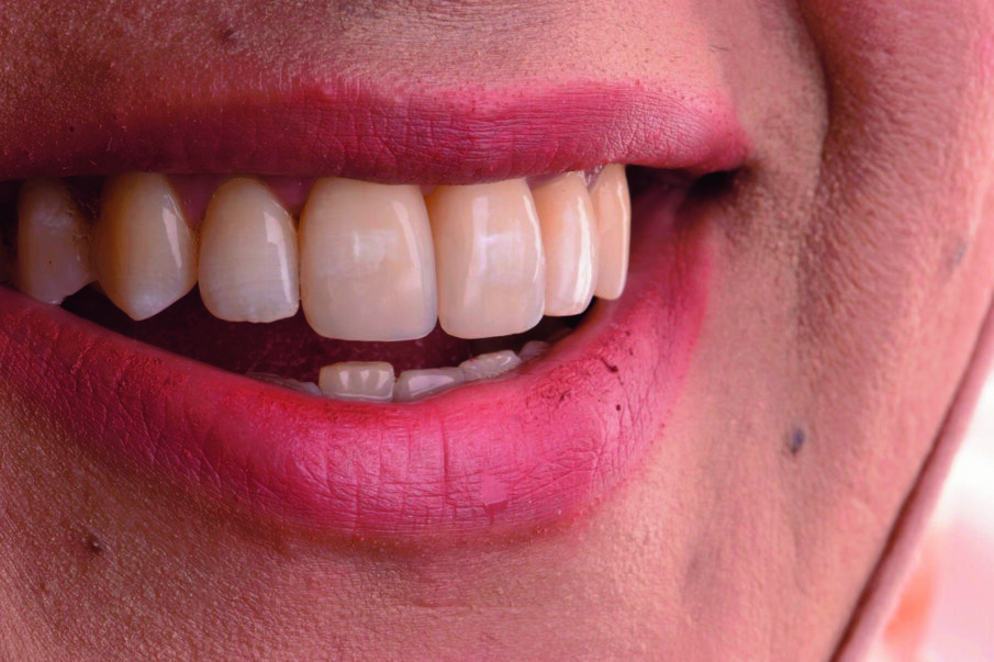 Fig 21. Rejuvenated smile achieved with MICD restorative approach