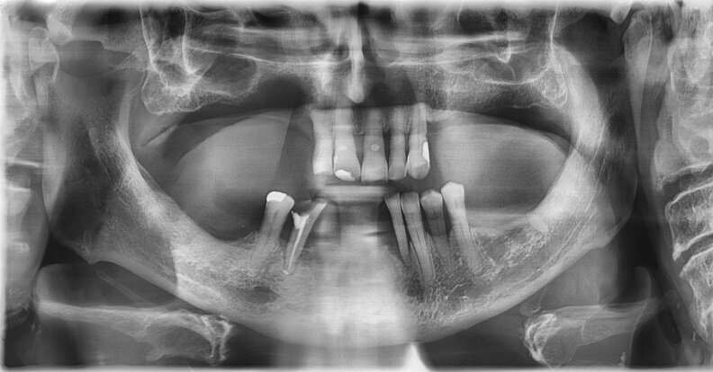 Ryc. 8_Zdjęcie pantomograficzne – stan 3 miesiące po zabiegu.