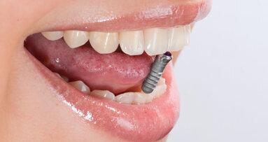 Studienvergleich: Implantate überzeugen