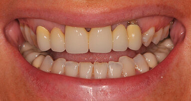 Disarmonia degli elementi frontali