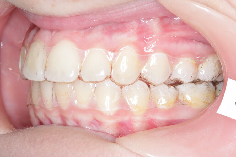 Fig. 13: Intermediate stage of Reveal aligners.