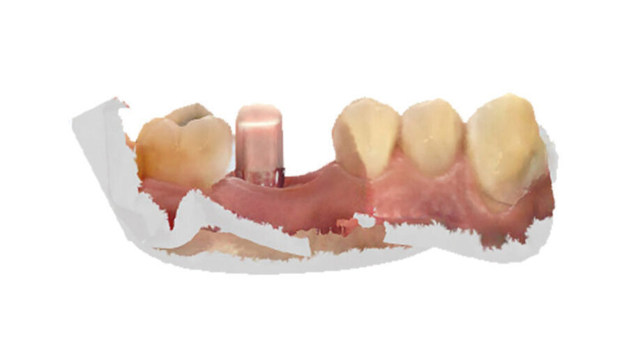 Fig. 3 - Scansione intra-chirurgica con scanbody.