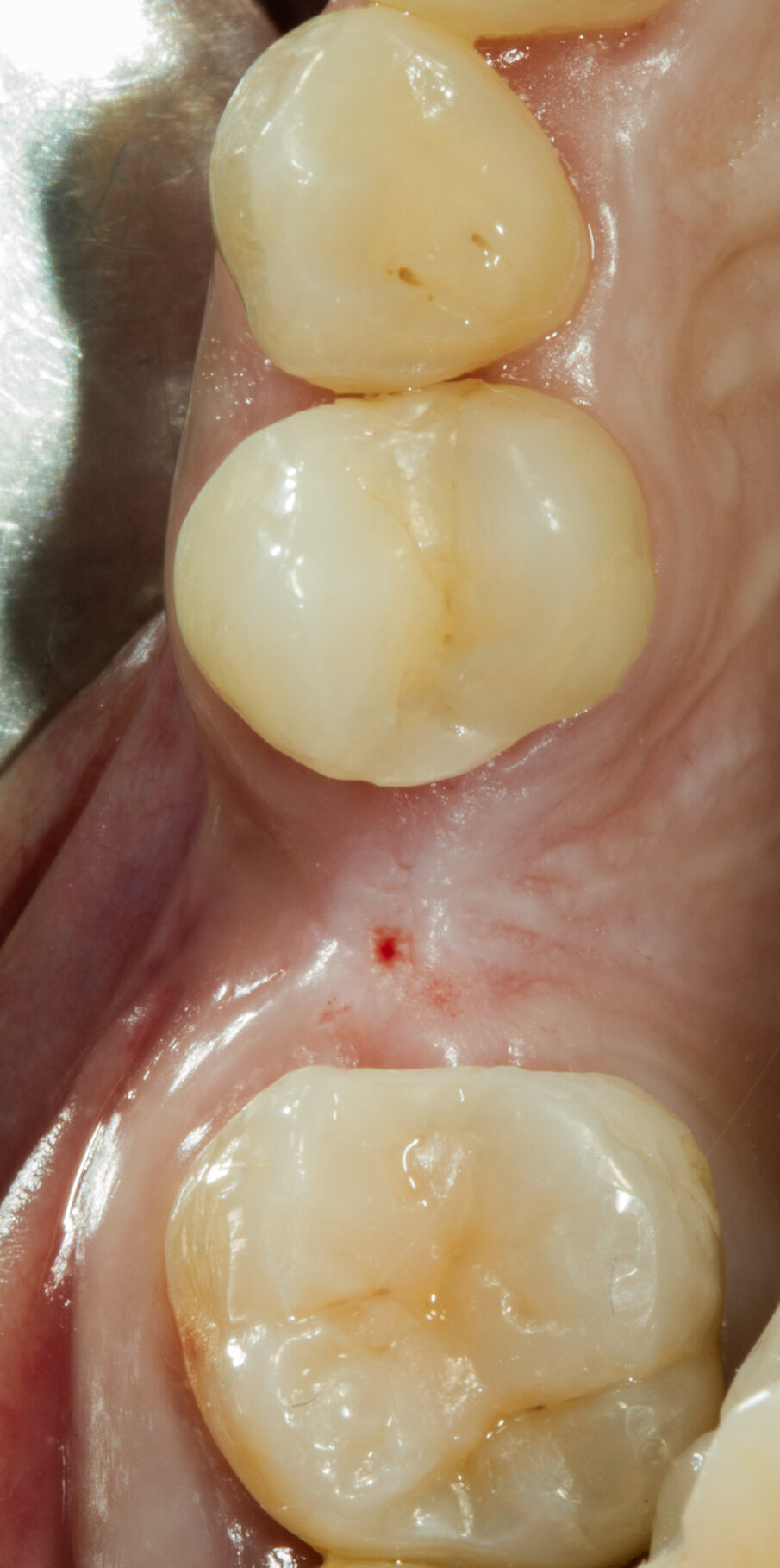 Fig. 3 - Situazione iniziale. Vista occlusale.