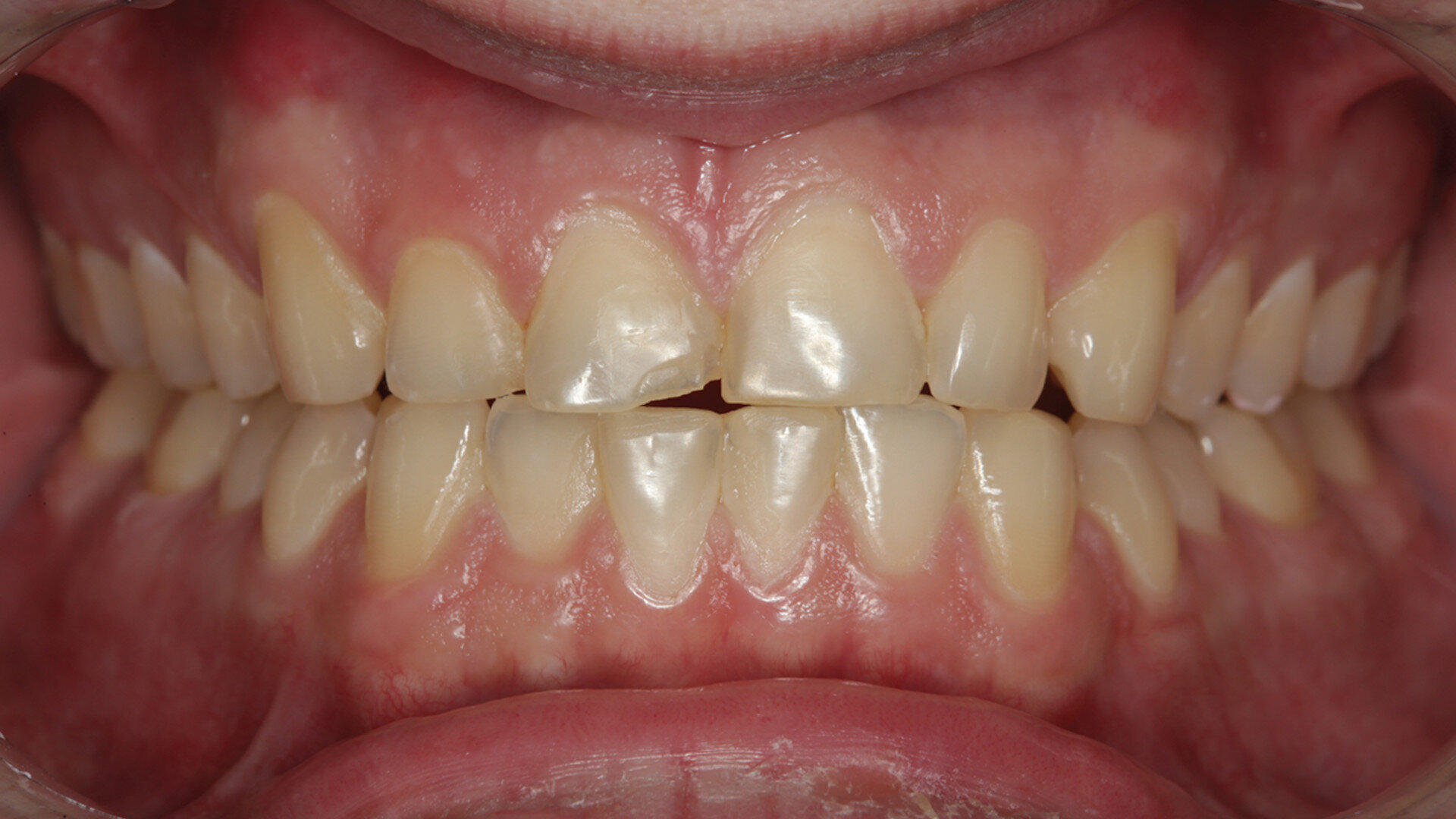 Conservative and necessary: How occlusion can affect a single-tooth replacement
