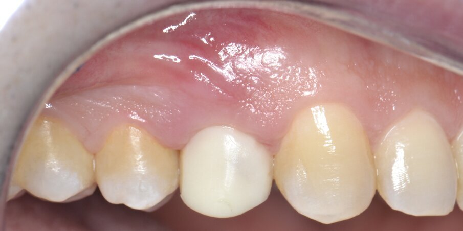 Fig. 19 - Follow-up a 14 giorni.