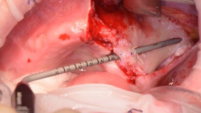 Il trattamento delle gravi atrofie mascellari con impianti zigomatici: una nuova Tecnica Minimamente Invasiva con strumentazione piezoelettrica