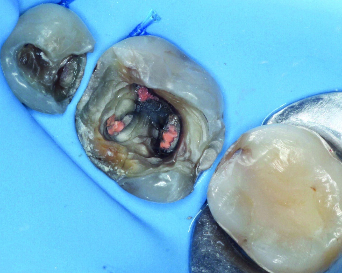 Fig. 2: Dental dam isolation for removal of the old restoration from tooth #45 using ultrasonic instrumentation. 