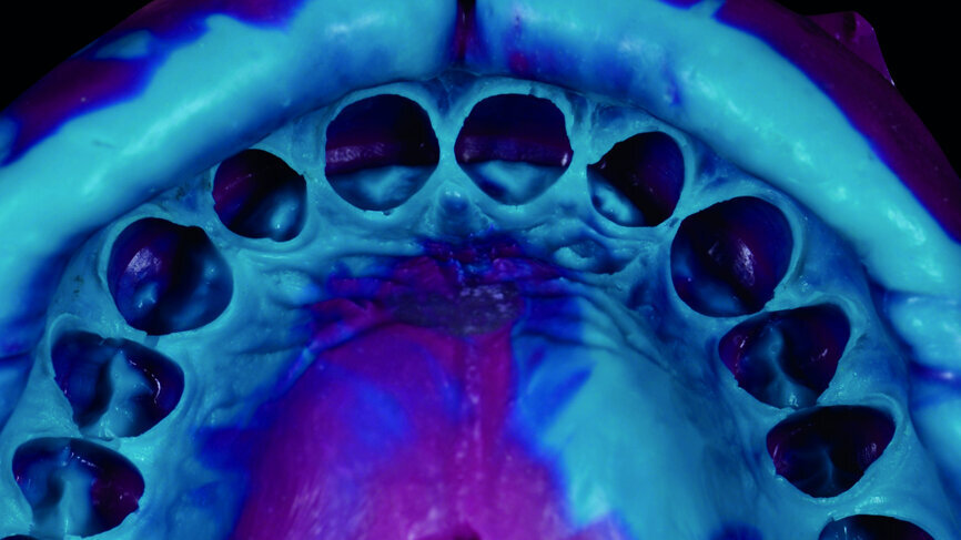 Fig. 10: Analogue impression with polyvinylsiloxane.