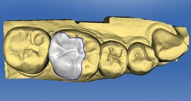 The digitized occlusion: Using something old with something new