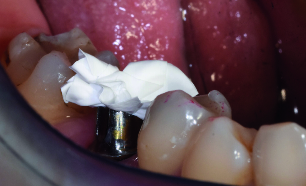 Fig. 23 : Teflon mis dans le fût du pilier.