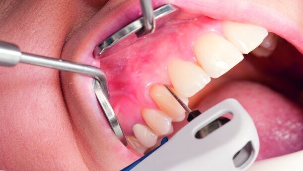 Ultradźwięki pomagają w walce z chorobami przyzębia