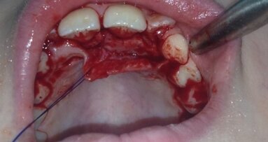 Standard postępowania przy operacyjnym usunięciu mesiodensu od strony podniebiennej