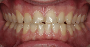 Conservative and necessary: How occlusion can affect a single-tooth replacement