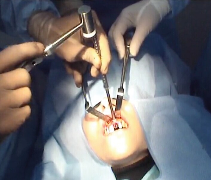 Fig. 7 : Impaction de la carotte osseuse au maillet et ostéotome.