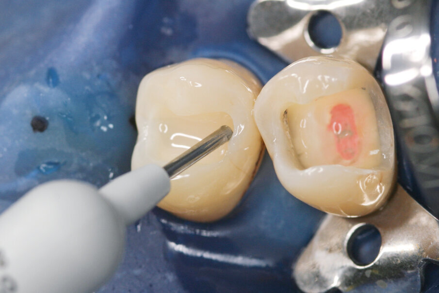 Fig: 5. Bulk-filling (one increment, up to 4mm) of the Class I cavity with SDR® Plus and subsequent light-curing for 20 secs.