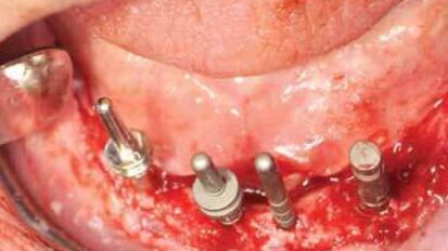 Leczenie implantoprotetyczne atroficznej żuchwy