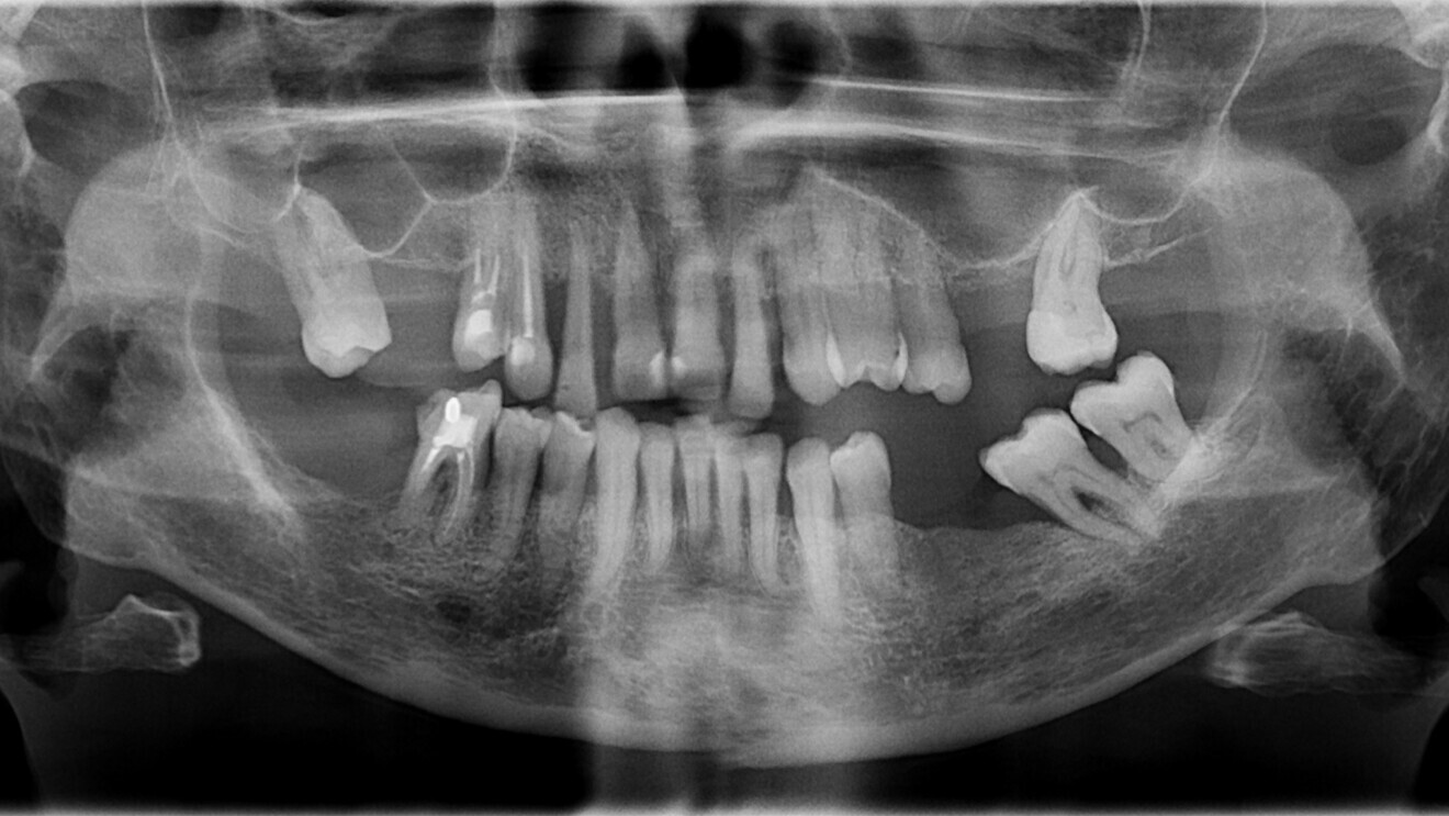 Fig. 2: Panoramic radiograph before treatment.