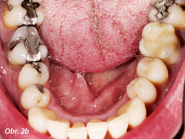 Pacient požadoval výměnu amalgámových výplní v horní (a) a dolní (b) čelisti za celokeramické náhrady.