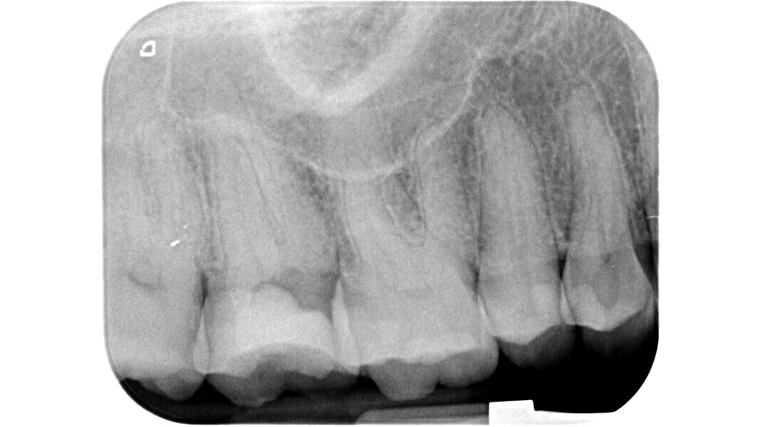 Fig. 1 : Radiographie préopératoire d’une molaire supérieure ayant nécessité un traitement d’urgence dans un autre cabinet dentaire.