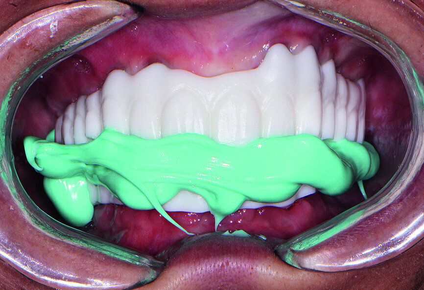 Fig. 20: PMMA Smile Composer.