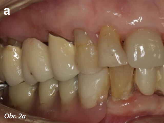 Počáteční stav chrupu: pravá strana (a) a levá strana