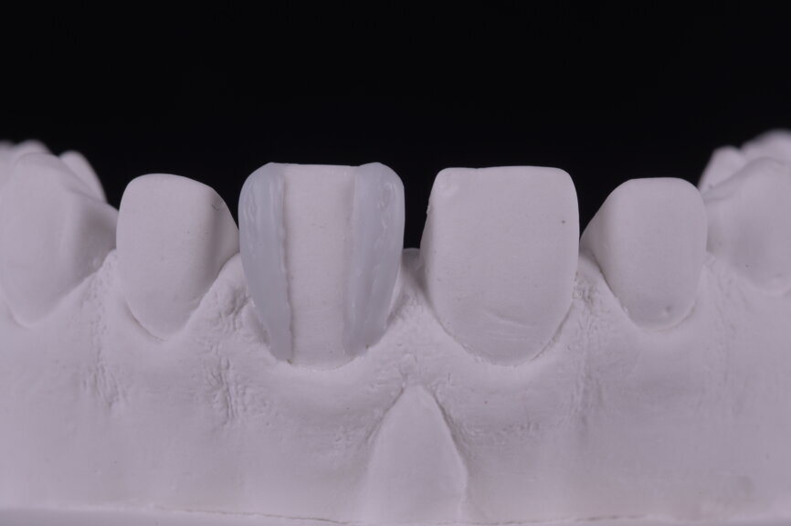 Fig. 20: Facial transition
lines.