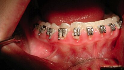 Gengivoplastica eseguita con Laser CO<sub>2</sub> coadiuvato dalla tecnologia LED